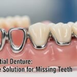 Metal Partial Denture