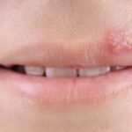 Folliculitis Versus Herpes