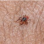 Granulomas from Tick Bite