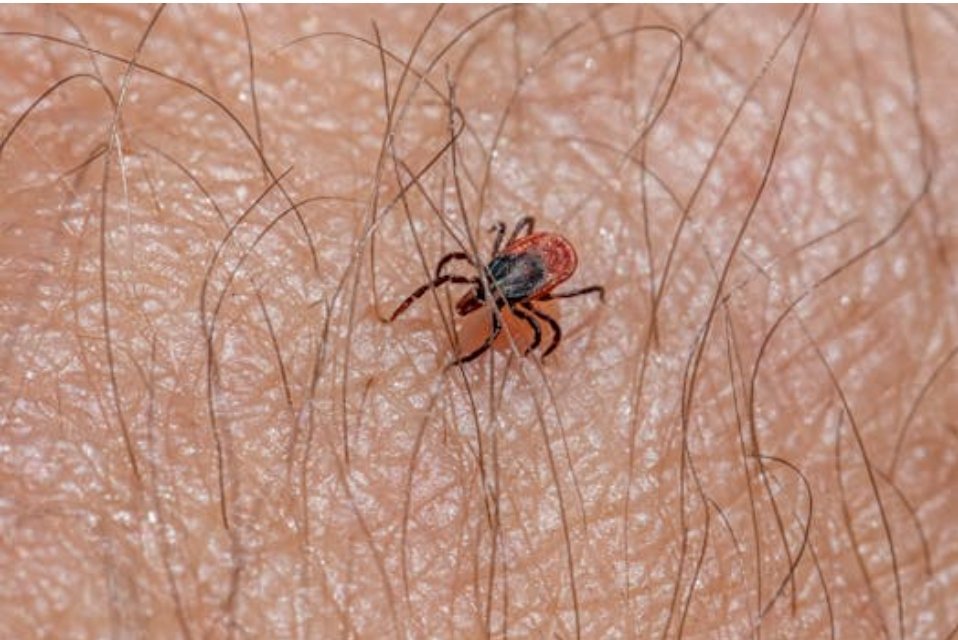 Granulomas from Tick Bite