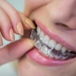 Everything You Need to Know Before Getting Invisalign in India