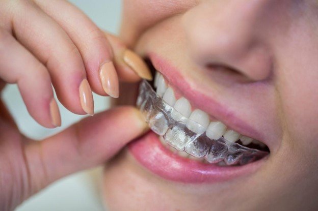 Everything You Need to Know Before Getting Invisalign in India