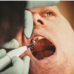Guided Tissue Regeneration