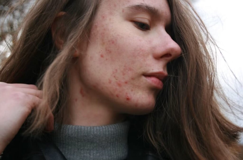 Sebaceous Cyst