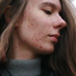 Sebaceous Cyst