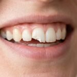 Chipped Tooth