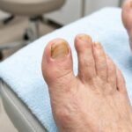 Curved Toenails