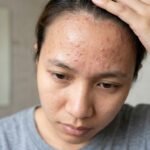 Fungal Acne
