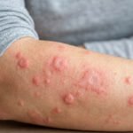 Hives on Skin