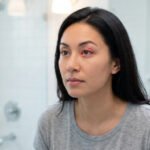 How to Treat a Stye