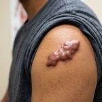 Keloid Scar