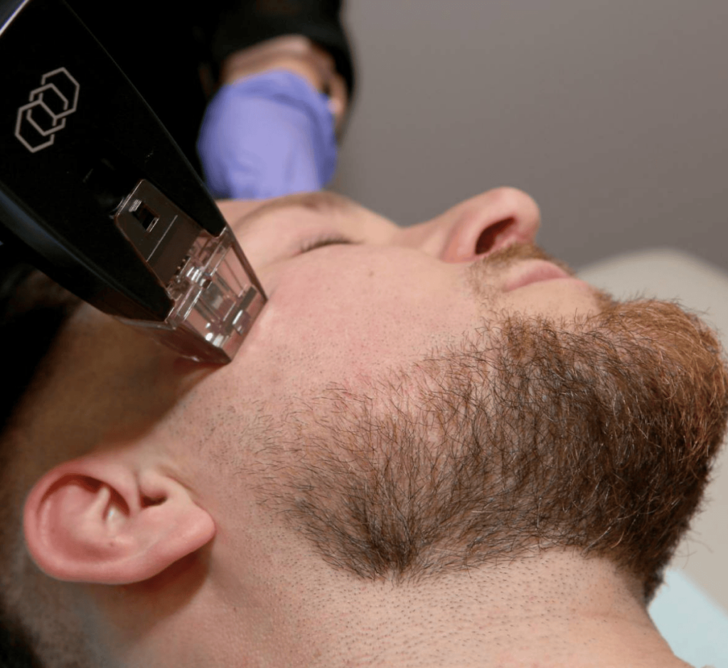Renew Your Confidence with Microneedling Face Treatment at Premier Wellness Florida.