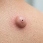 Sebaceous Cyst