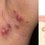 HS Skin Condition
