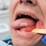 Oral Cancer Symptoms