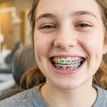 Braces Colors