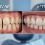 Composite Veneers